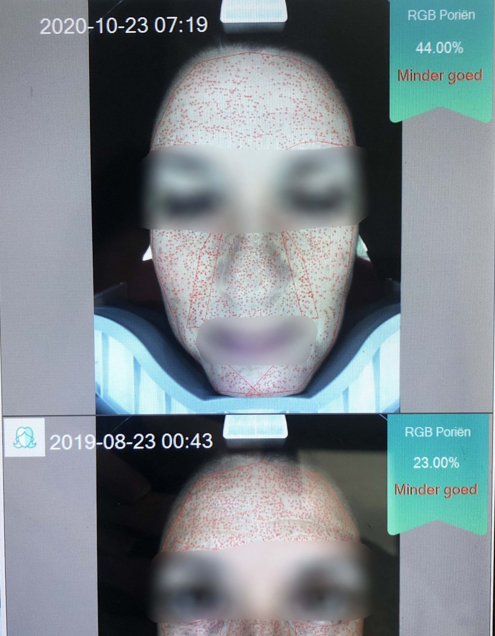 Microneedling resultaat voor en na