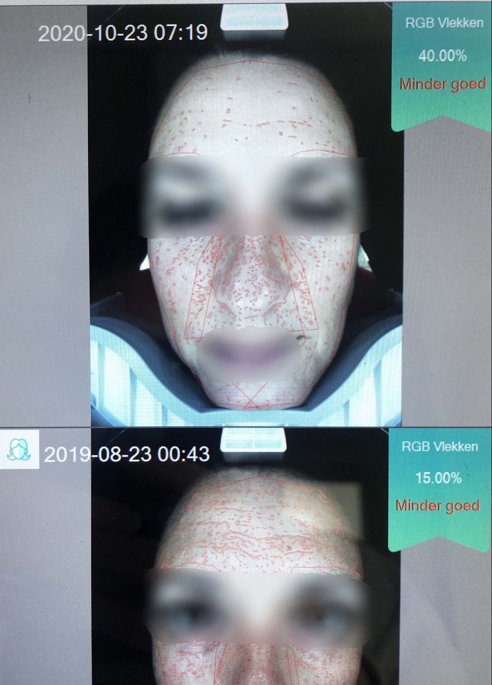 Microneedling resultaat voor en na acné