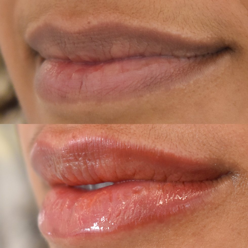 Resultaat lip enlightenment