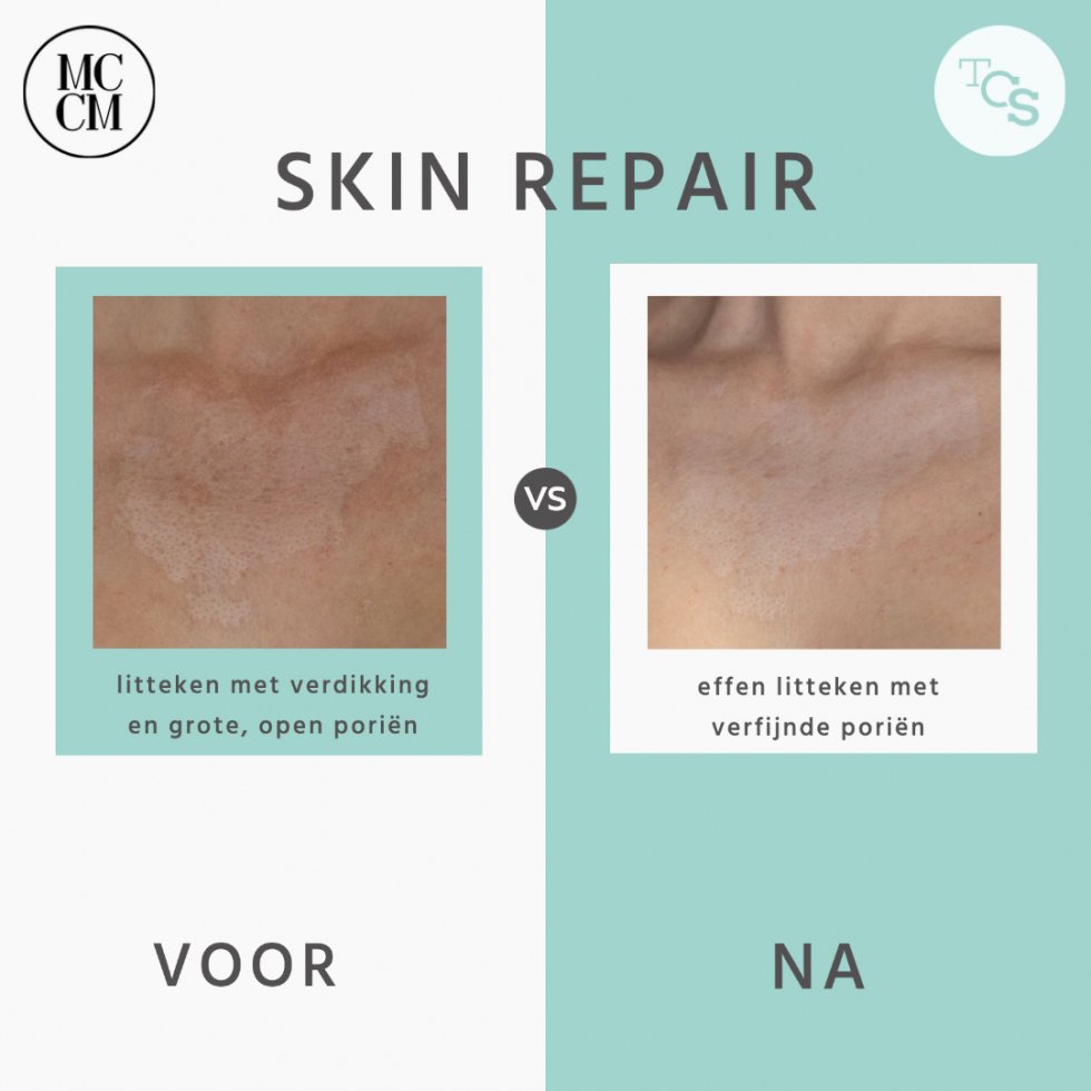 Skin repair - litteken