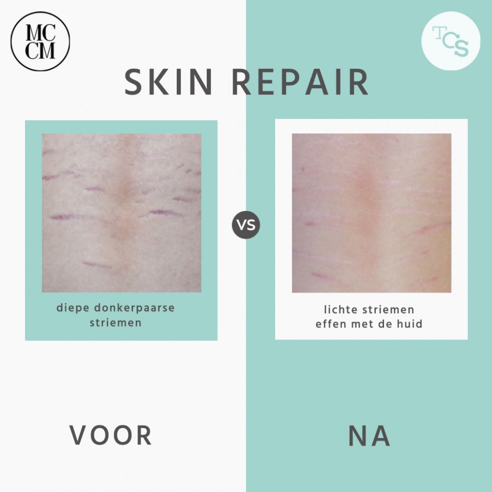 Skin repair - striemen