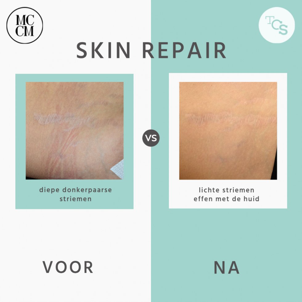 Skin repair - striemen