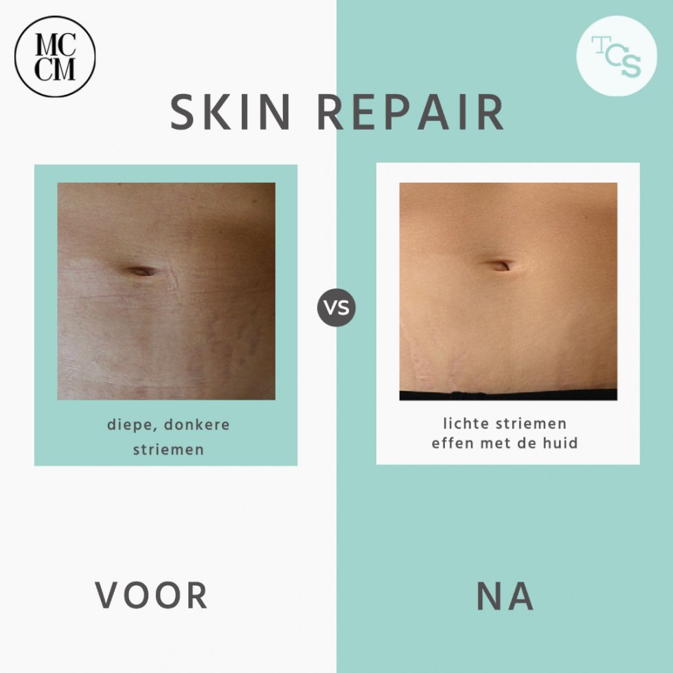 Skin repair - striemen