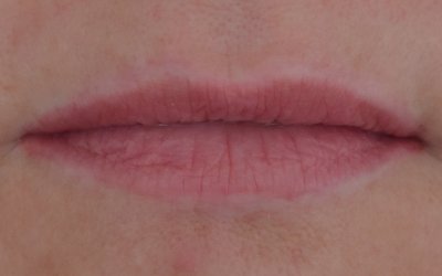 removal lippen