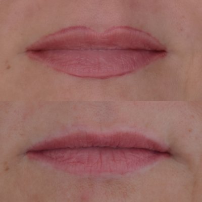 removal lippen