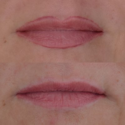 détatouage lippen 