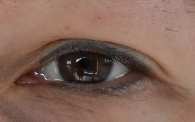 non laser removal