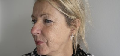 Microneedling behandeling verminderd diepe rimpels 