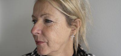 Le traitement par microneedling réduit les rides profondes