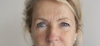 microneedling stimuleert collageen
