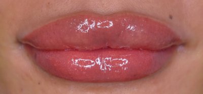 lip neutralization