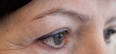 Résultat guéri pour le traitement de l'alopécie des sourcils 
