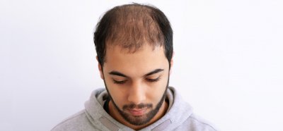 traitement de la perte de cheveux par micro pigmentation capillaire 