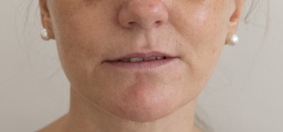 Microneedling huidverjonging