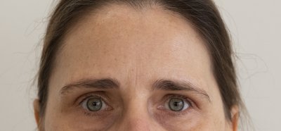 Hyperpigmentatie & anti aging