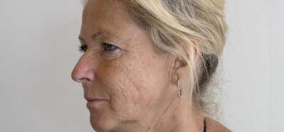 Huidverjonging door mesopeel en microneedling 