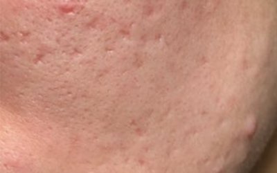 Voor acne behandeling 