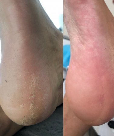 Yumi Feet callosités sur les pieds