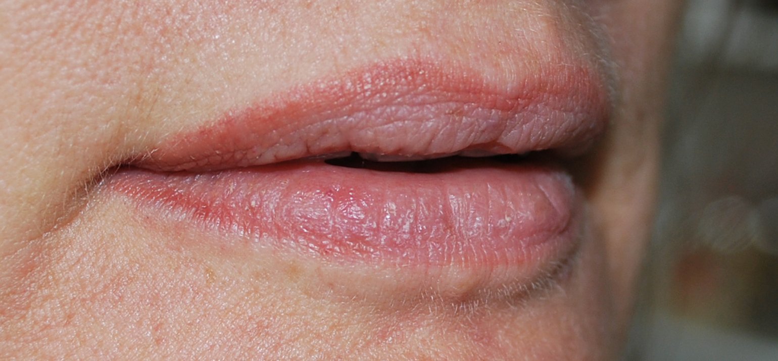 Une SPM traîtement permanent lèvres 