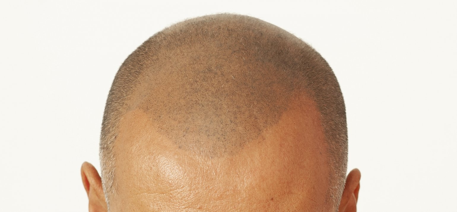 Oplossing haaruitval scalp pigmentatie