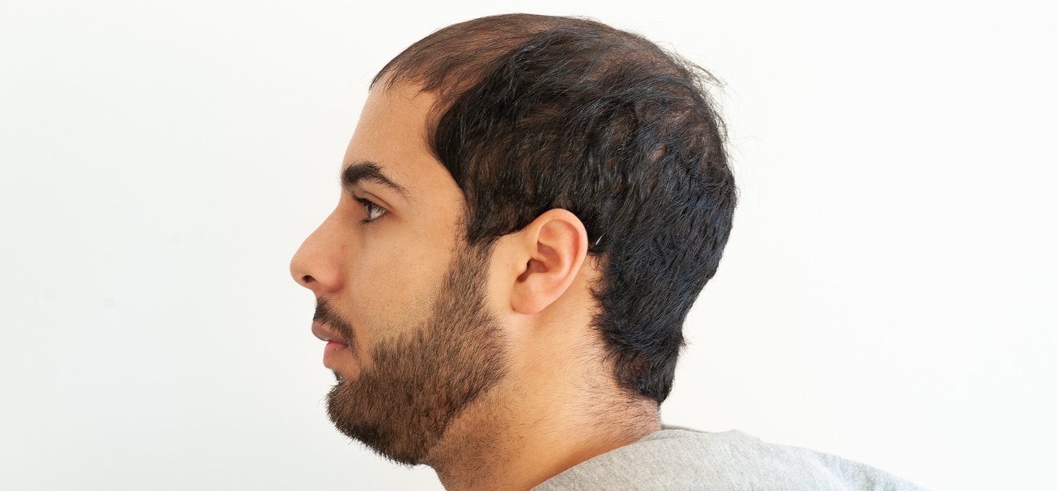 Haaruitval mannen camoufleren met scalp pigmentatie
