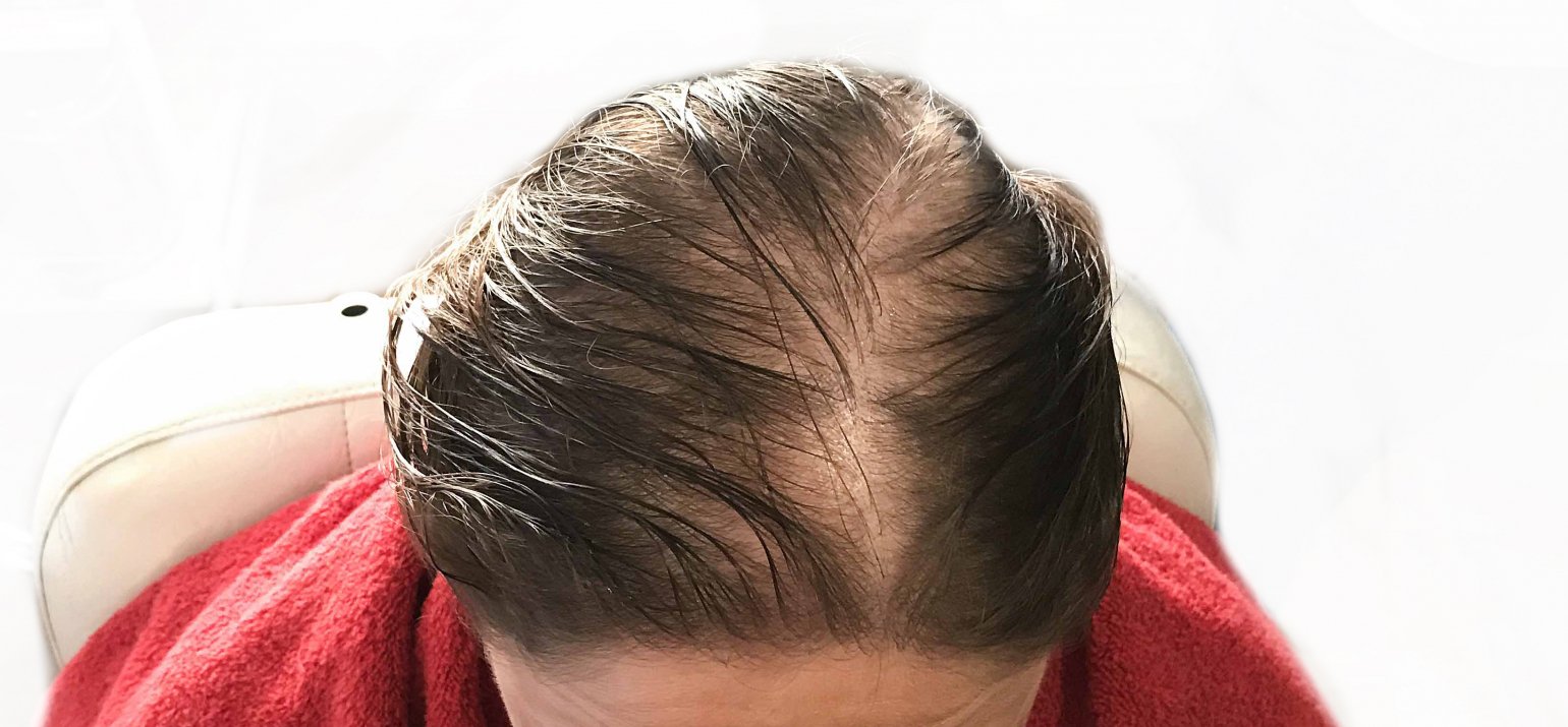 Traiter la perte de cheveux : créer de la densité capillaire| The ...