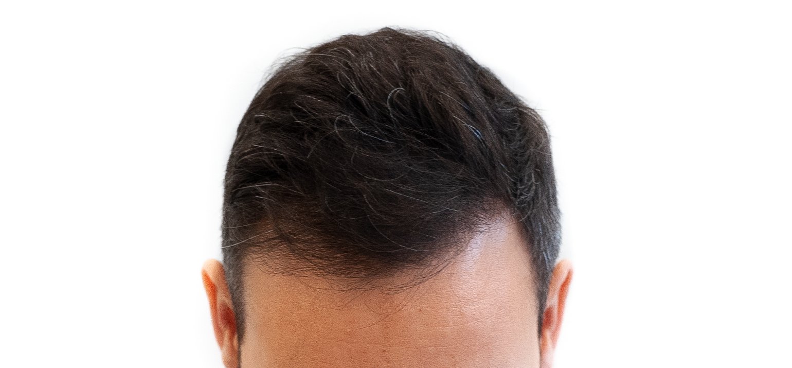 Haaruitval mannen camoufleren met scalp pigmentatie Tricopigmentatie