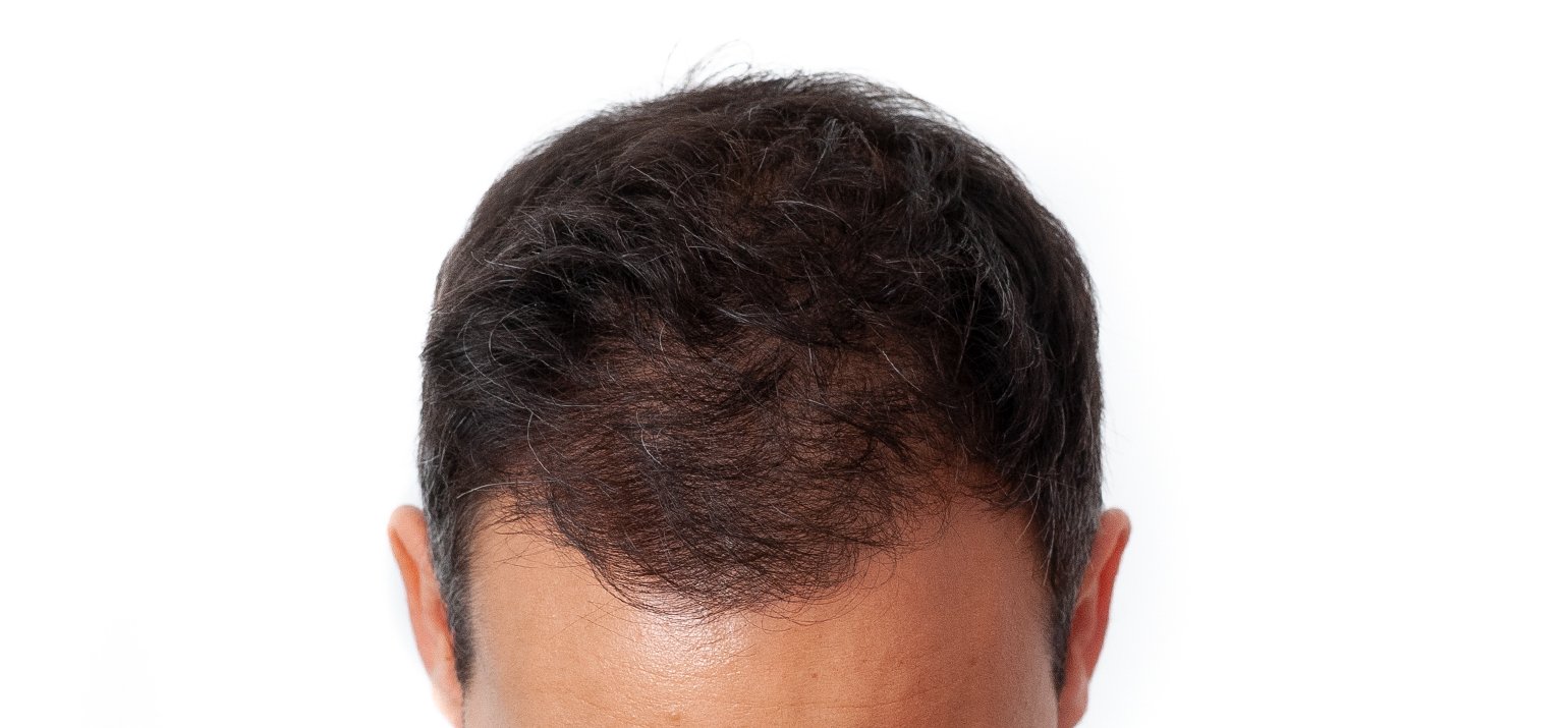 Haaruitval mannen oplossen met scalp pigmentatie
