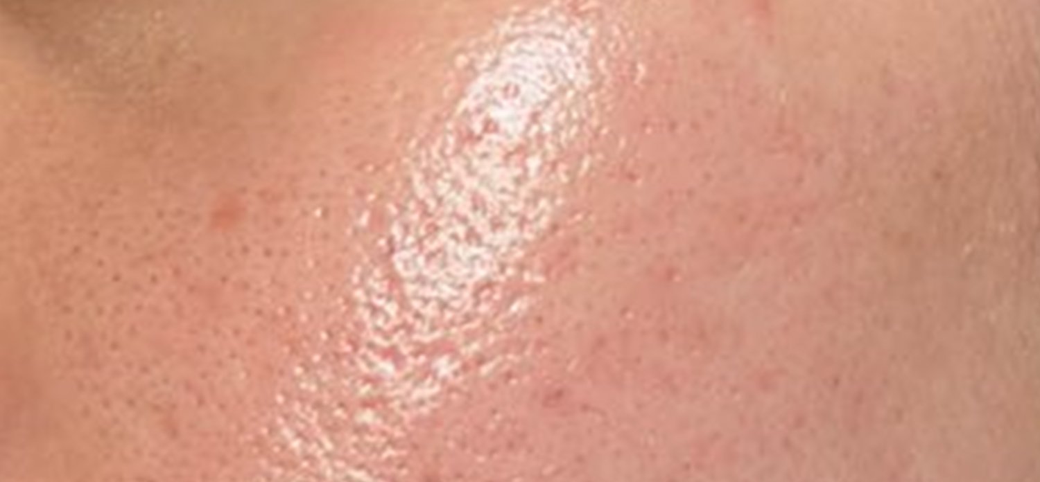 microneedling acné na behandeling TCS