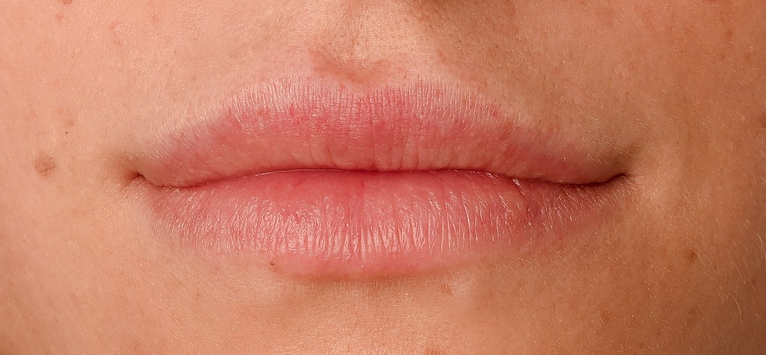 Lip Enhancement