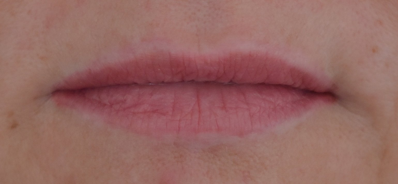 détatoeage lippen