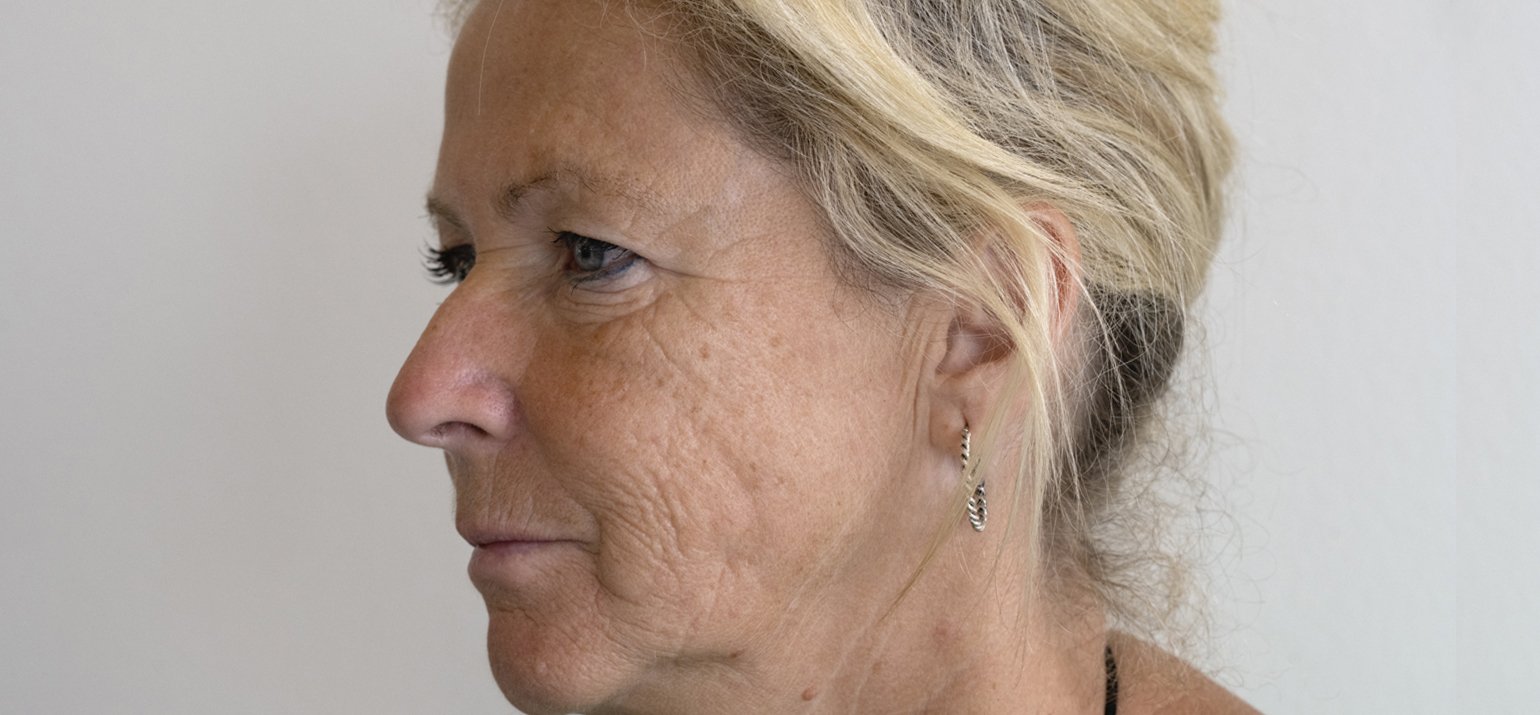 Traitement par microneedling avant et après