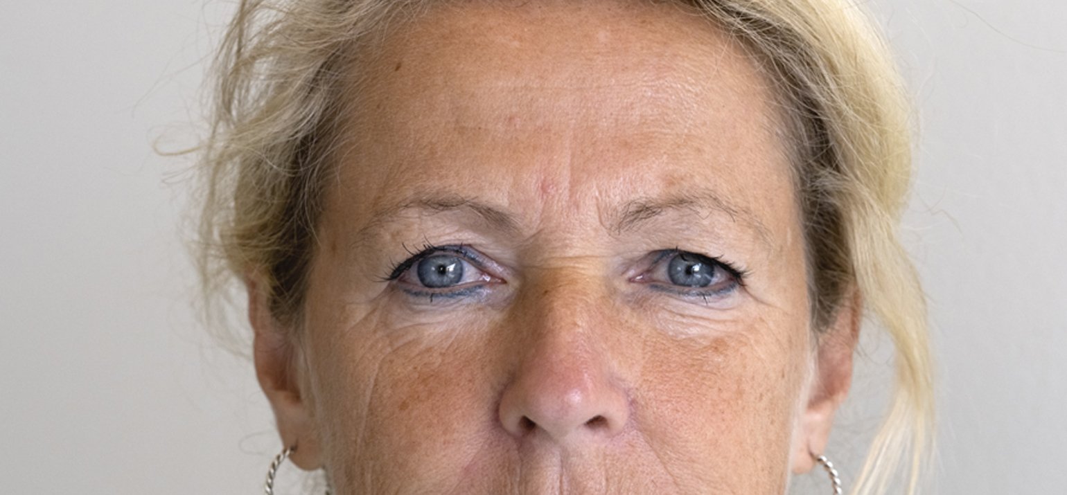 Microneedling et mesopeel contre les taches pigmentaires du visage