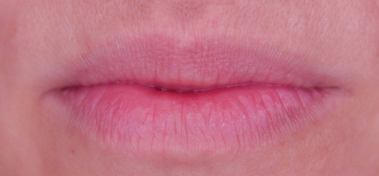 mild lip neutralization