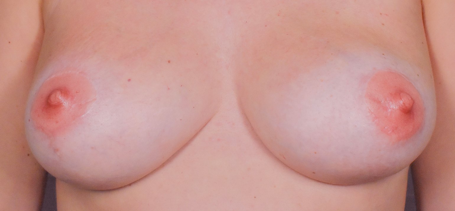 Areola pigmentation