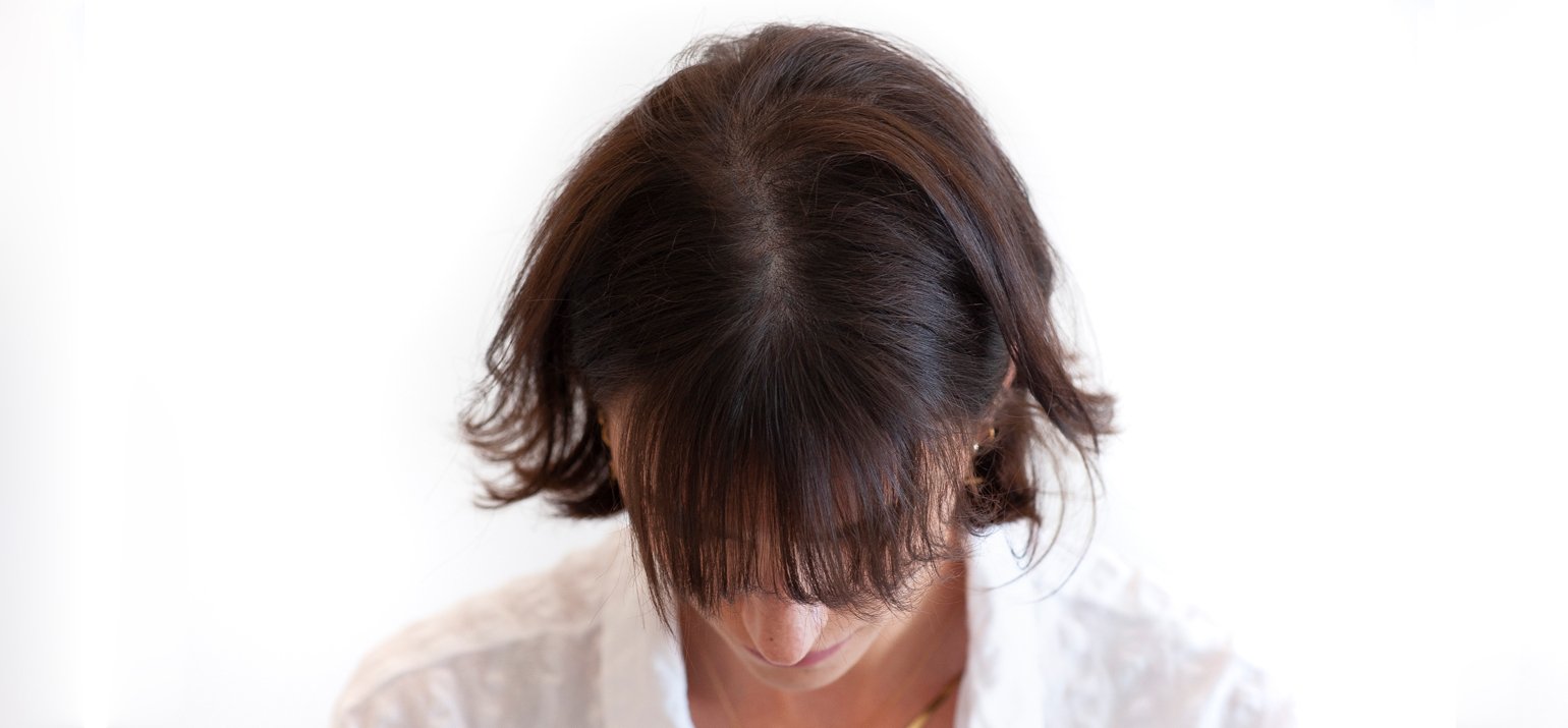 SMP solution pour les femmes souffrant de perte de cheveux