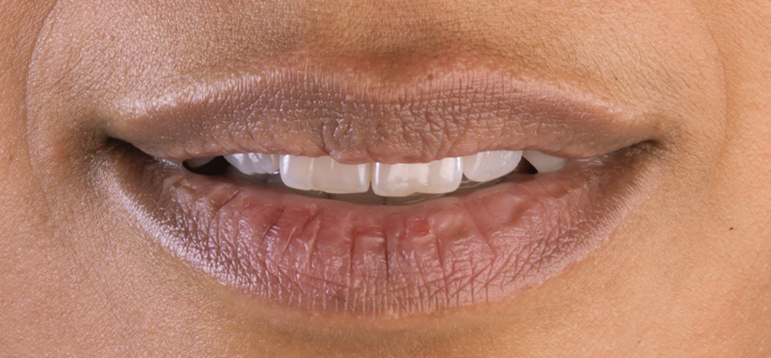 pigmentation des lèvres brun foncé avec des lèvres bleues brillantes