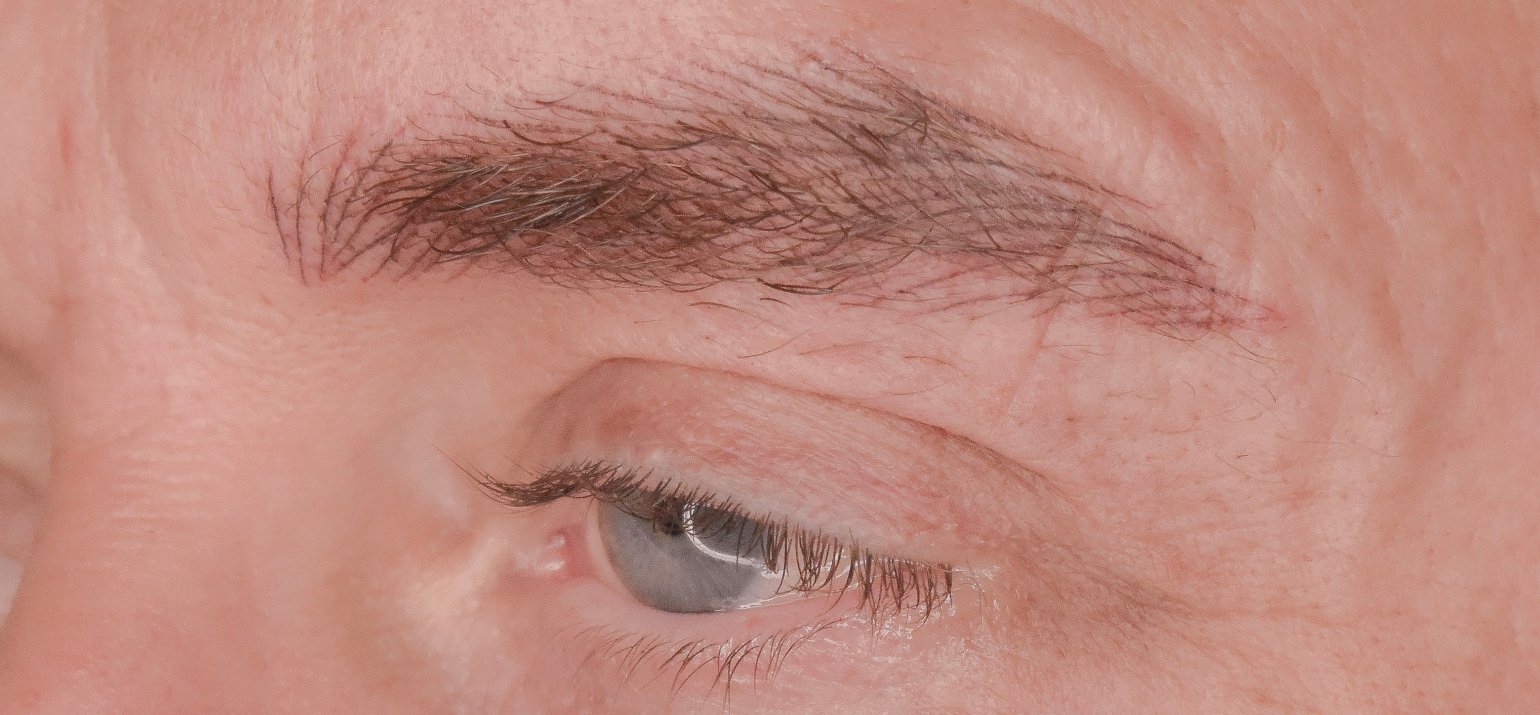 male brow reconstruction