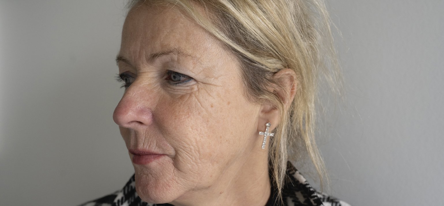 Behandeling tege huidverjonging