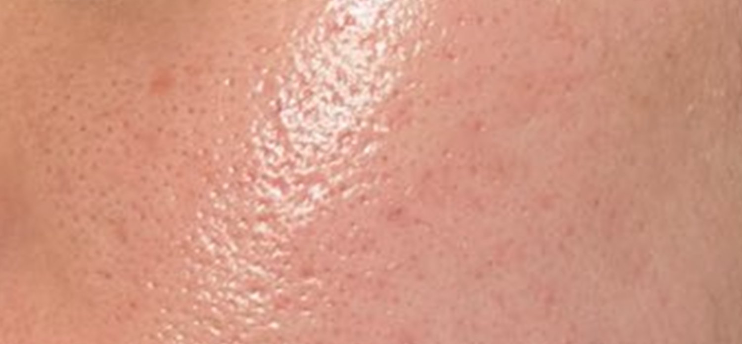 Acne behandelen met peeling 