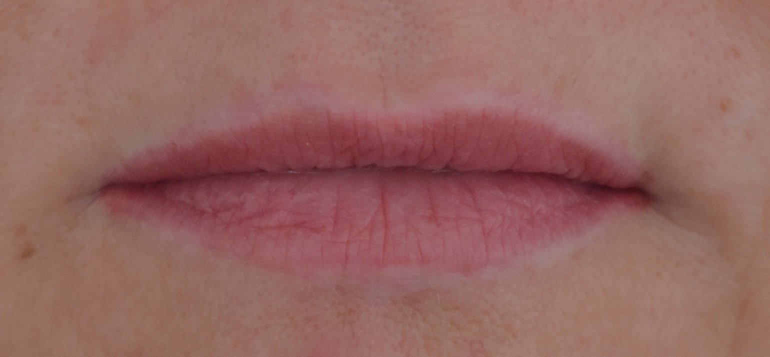 Lip contour verwijderen 