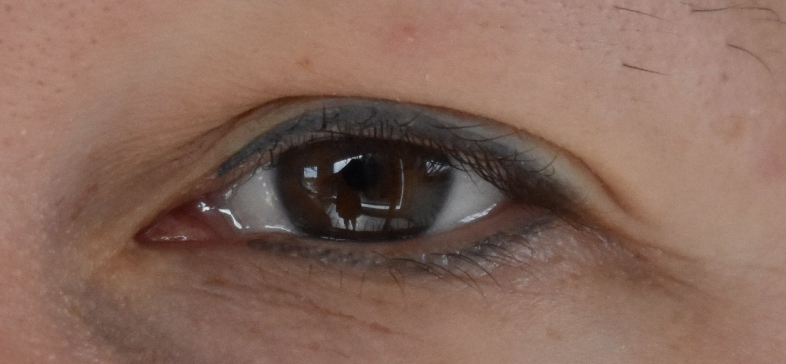 Vlekkige eyeliner verwijderen zonder laser 