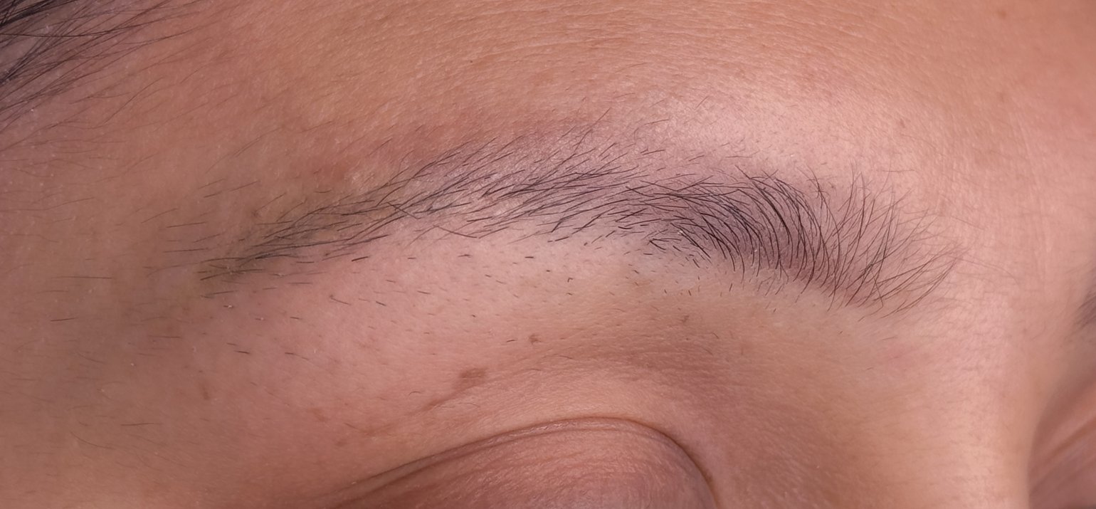 voor en na resultaten laser removal wenkbrauwen 